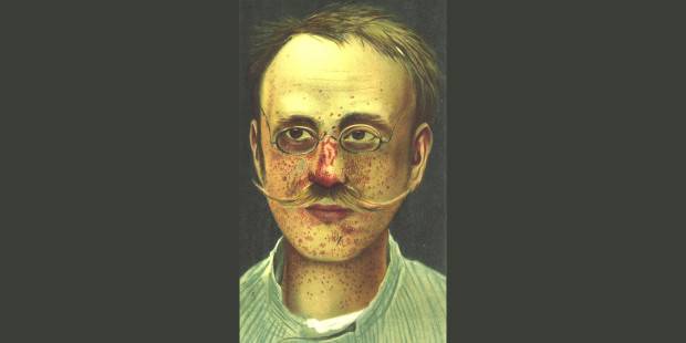 Zmiany skórne u pacjenta ze stwardnieniem guzowatym. Ilustracja z  1903 r.