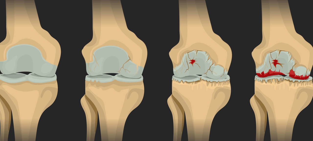 cel mai eficient tratament pentru artroza umărului artrita de gradul 4 al articulației genunchiului